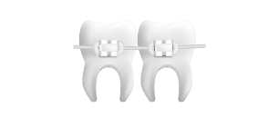 dientes con brakets ceramicos