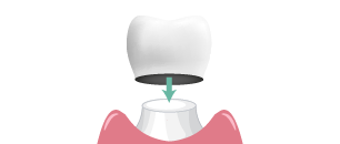 corona dental individual