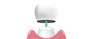 corona dental individual