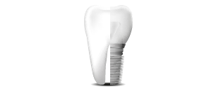 mantenimiento periodontal