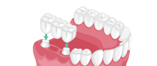 protesis dental fija
